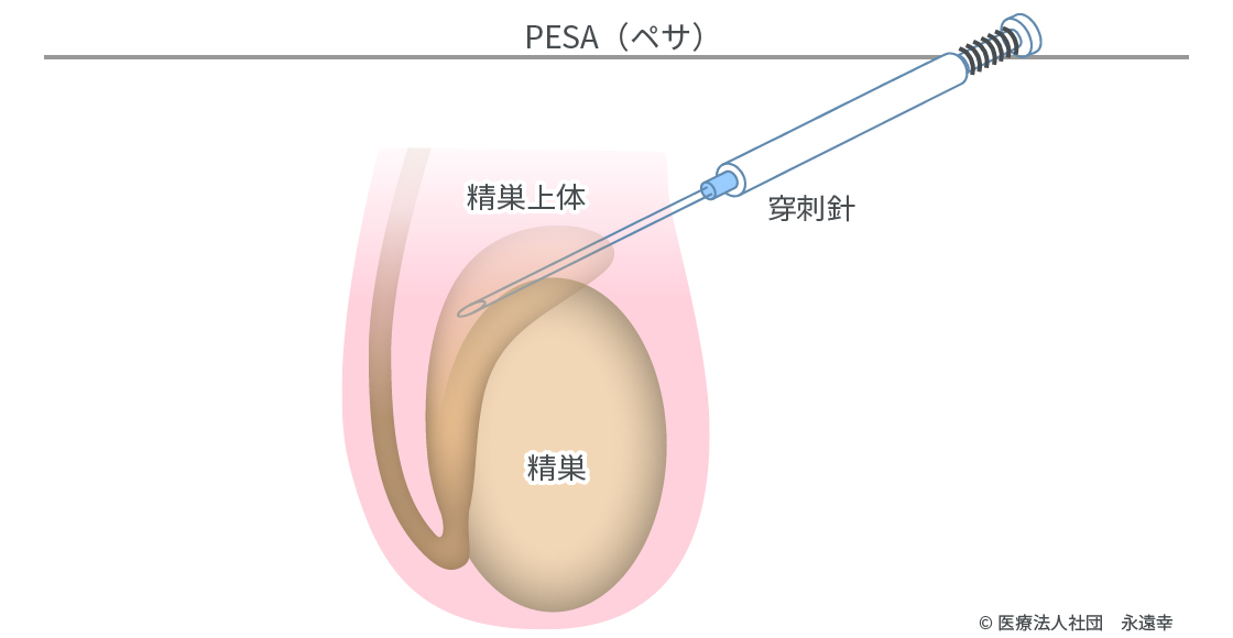 遅い 卵胞 成長