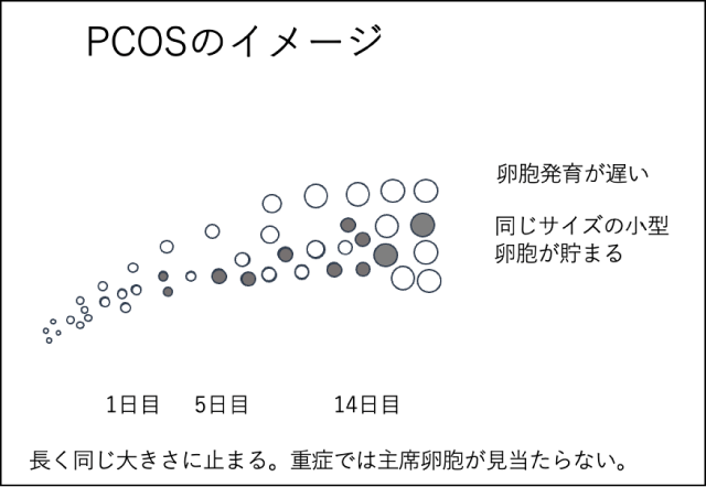 PCOSのイメージ図